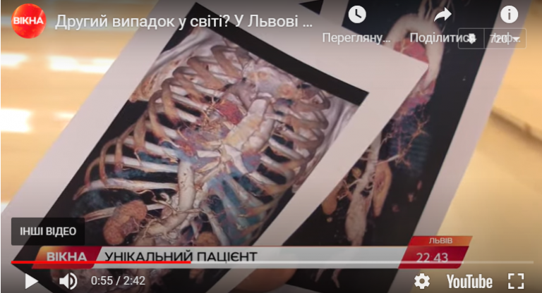 Такого хворого ще в житті не бачили: до Львівської лікарні потрапив чоловік із дзеркально розташованими органами (ВІДЕО) 4 Такого хворого ще в житті не бачили: до Львівської лікарні потрапив чоловік із дзеркально розташованими органами (ВІДЕО)