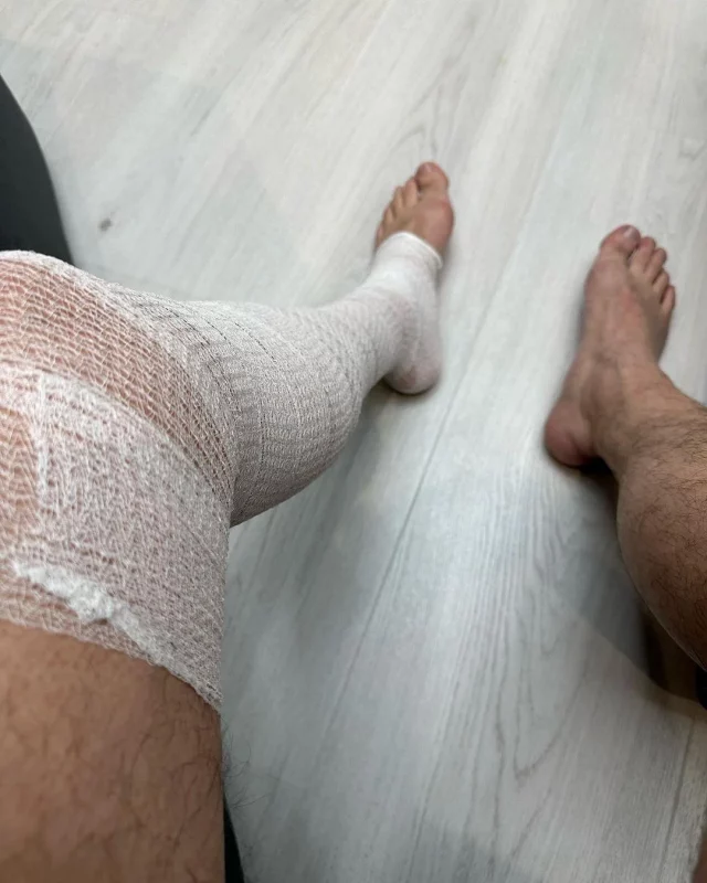 Відбрехався від гіпсу: Віталій Кім отримав серйозну травму (ФОТО)