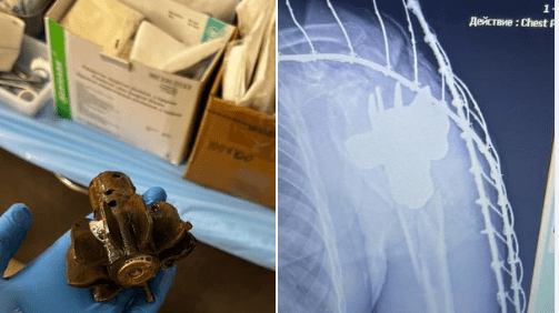Військові лікарі дістали хвостовик міни з тіла військовослужбовця: що з ним (ФОТО)