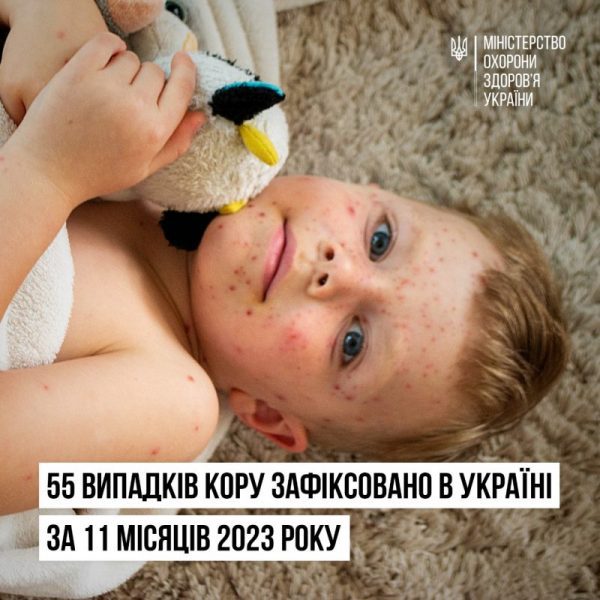 В яких регіонах України цього року зафіксували найбільше випадків кору