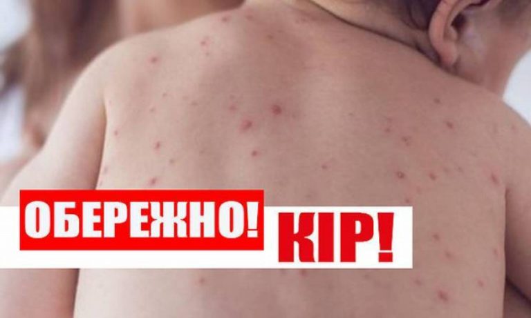 На Буковині спалах кору: за два місяці захворіли 29 людей 9 На Буковині спалах кору: за два місяці захворіли 29 людей