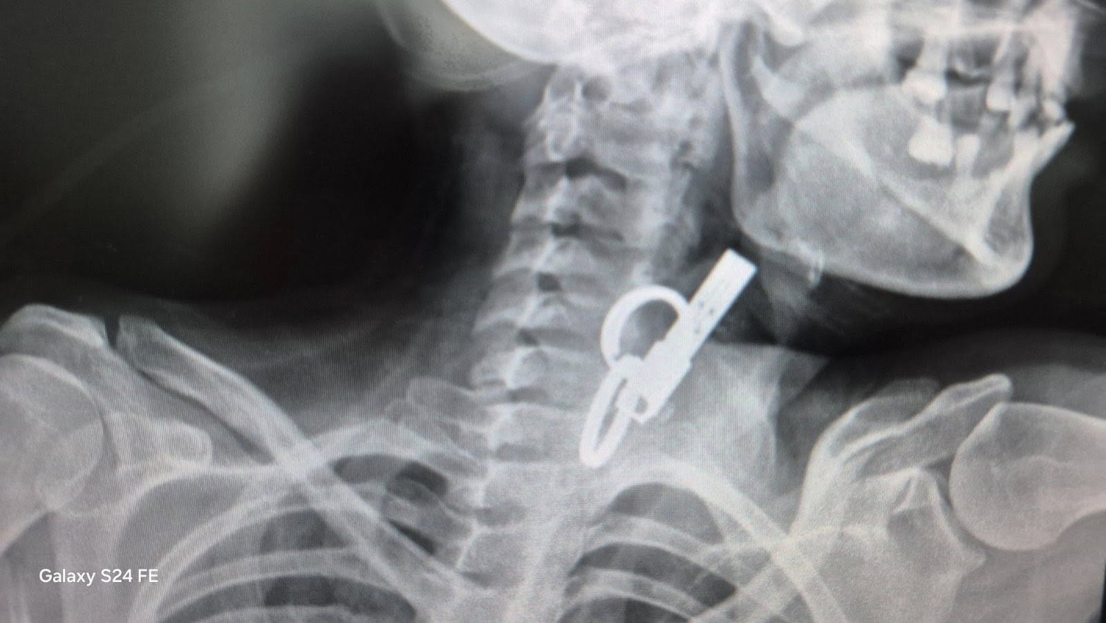 На Тернопільщині жінка проковтнула ключ (ФОТО) 1 616638471 122118948891041188 875160003221230361 n