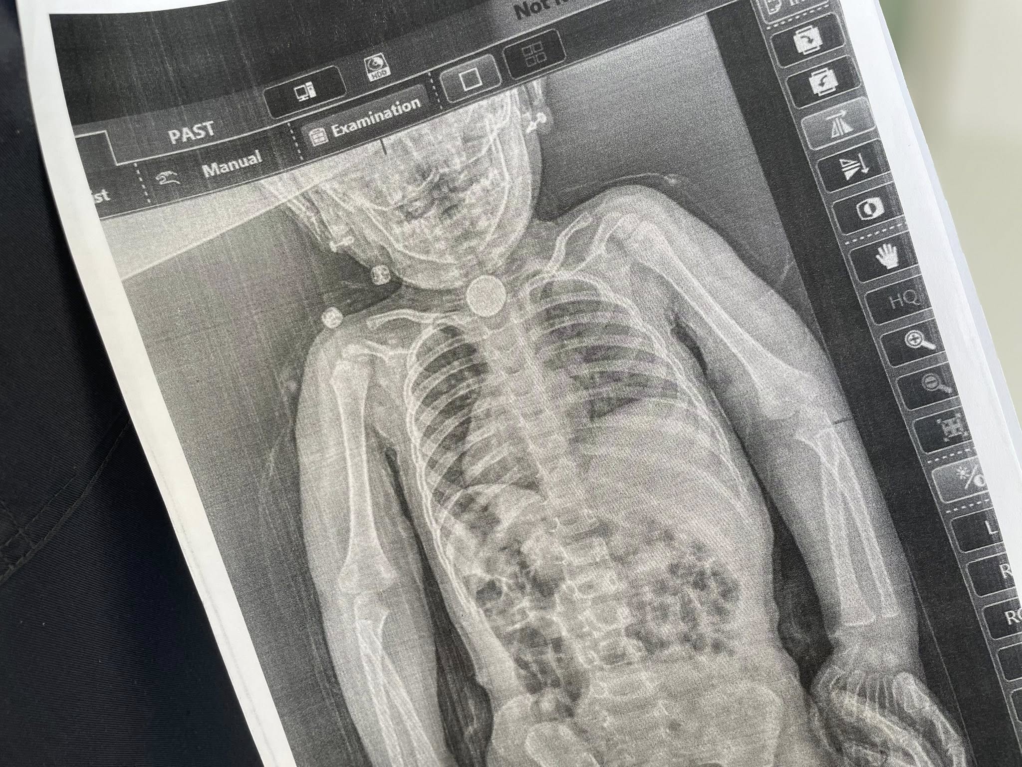 У Львові 2-річна дівчинка три місяці прожила із батарейкою в стравоході 2 666755293 122381472404086720 2279959488467790632 n