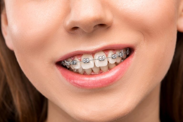 Скільки варто носити брекети для ідеального результату 11 How Long Do You Need to Wear Braces